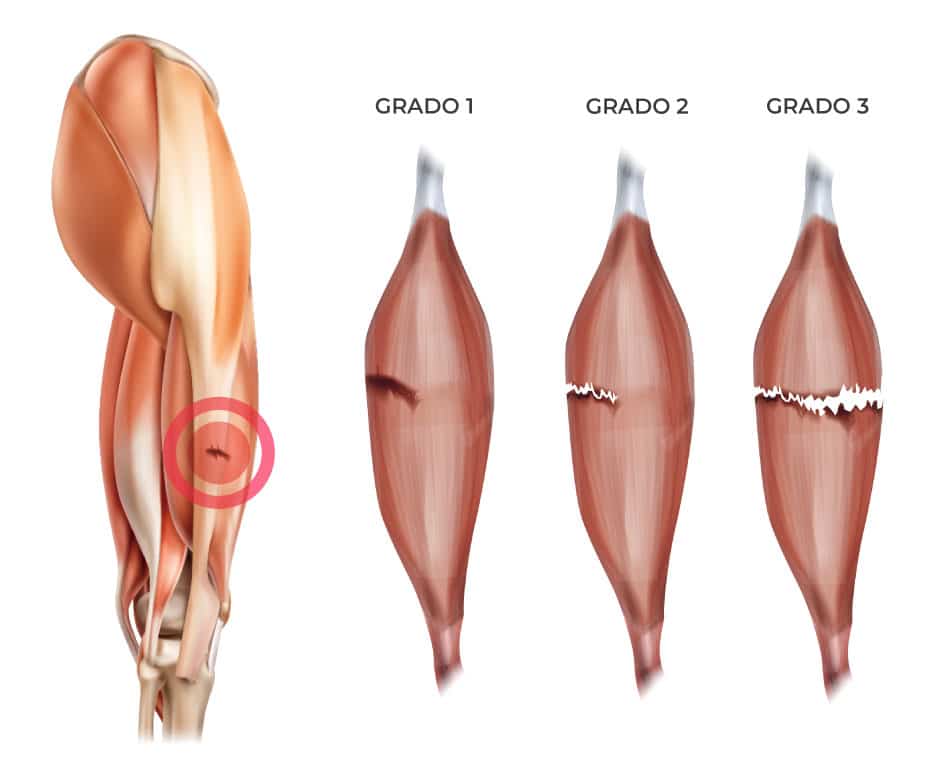 desgarro muscular