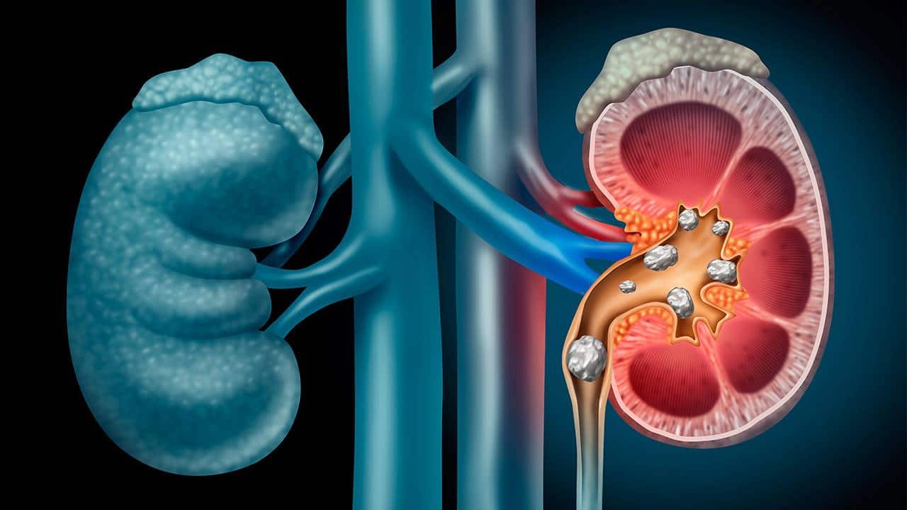 cólico renal