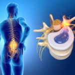 Discopatía y Hernia Discal: Causas, Tratamientos y Prevención