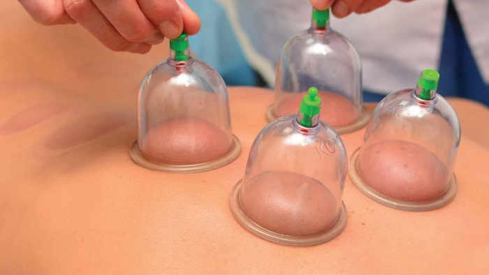 cupping